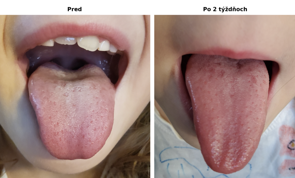Porovnanie jazyka pred a po 2 týždňoch užívania